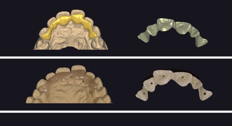 CAD/CAM-gefertigt: Retainer aus Zirkonoxid - Zahntechnik Mehlhorn